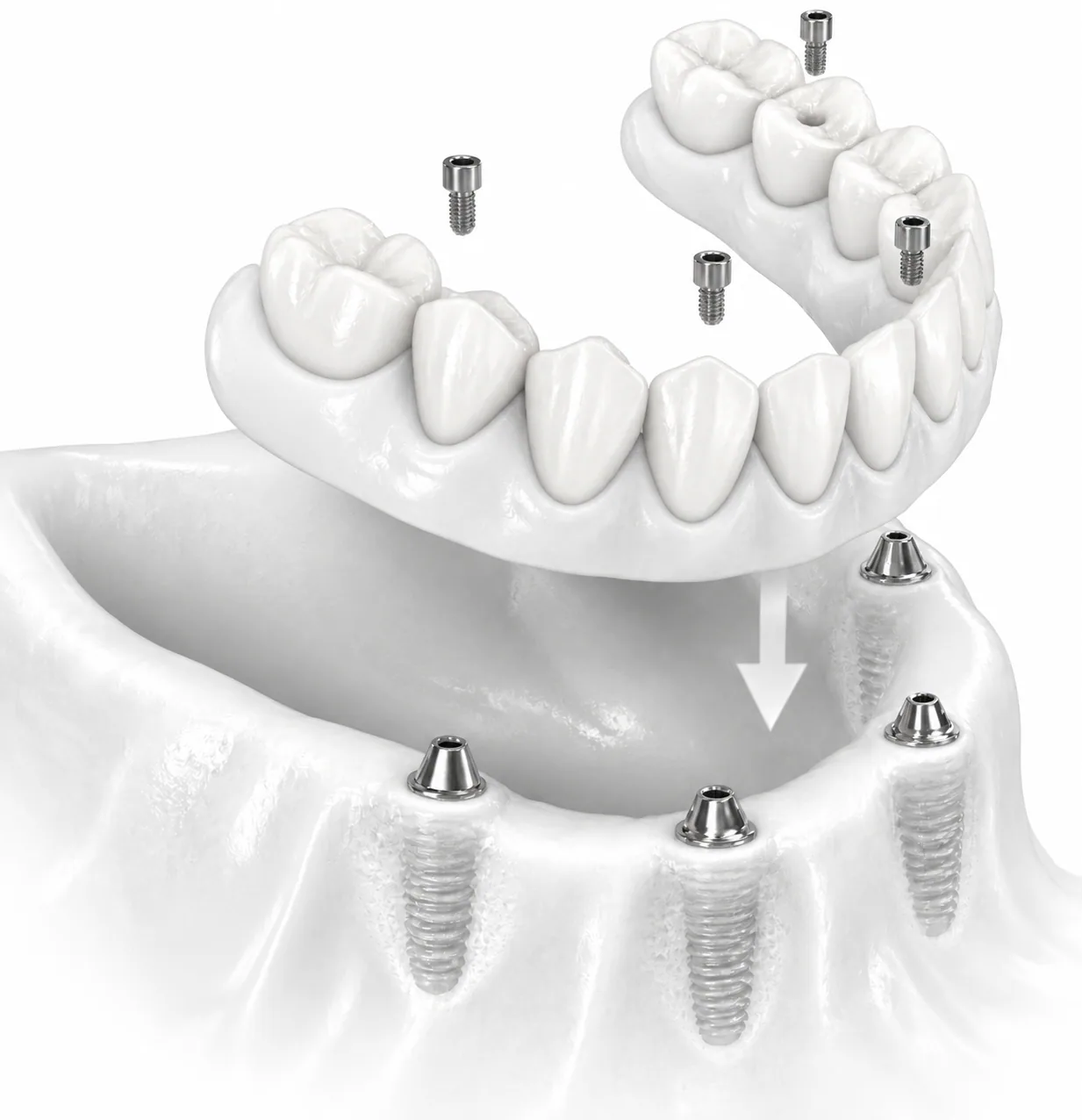 Implant-supported full-arch denture being placed onto four implants
