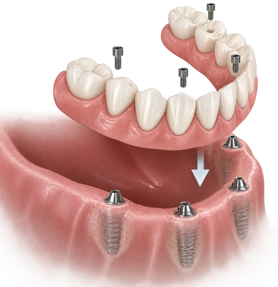 All-on-4 implant-supported denture