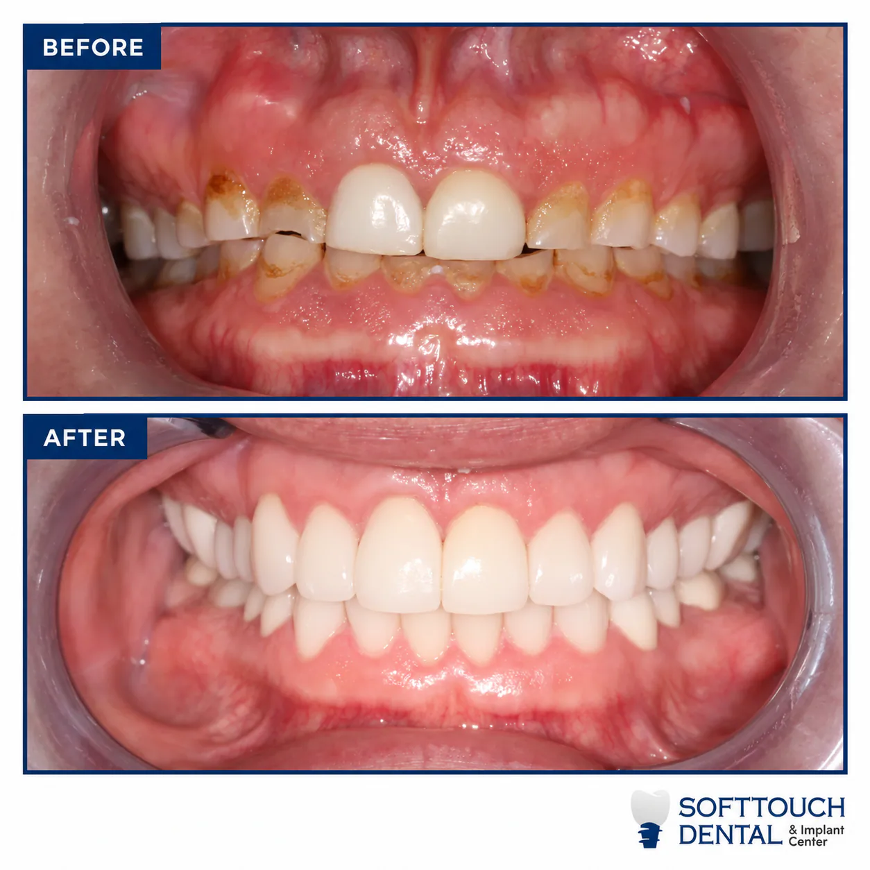 Before and after: stained, worn teeth restored to a bright, even smile