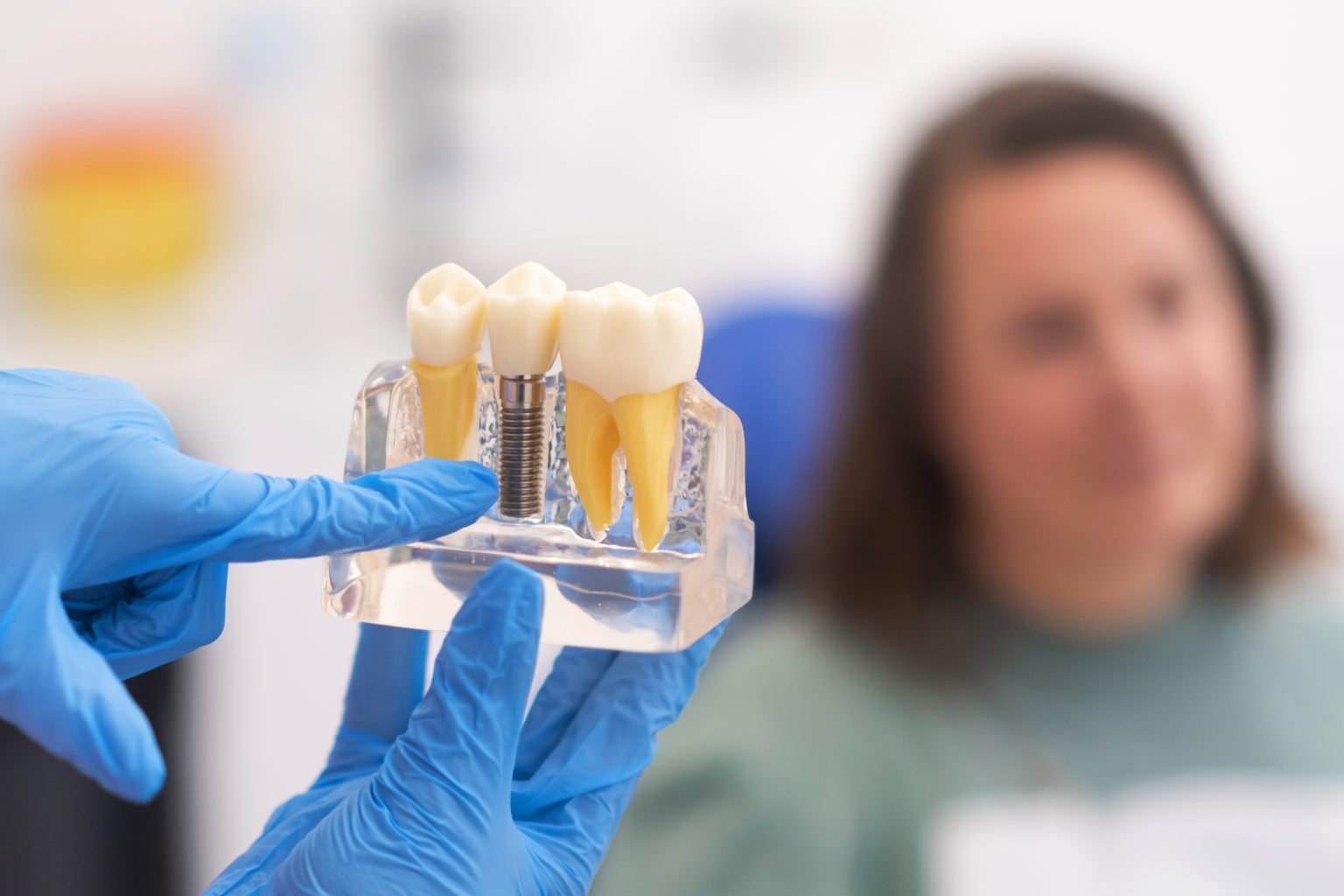 All-On-4 Dental Implants in Plano | Softtouch Prosthodontist